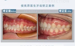 舌侧牙齿矫正方法有哪些？与传统矫正相比效果和舒适度如何？适合哪些人群选择？