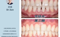 正畸时牙缝变黑，是矫正器影响还是清洁没做好？