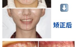 牙齿深覆合矫正容易吗？难度和周期具体如何？