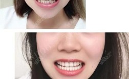 雨花区牙齿整形矫正效果如何？价格和流程是怎样的？