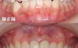 牙齿正畸后对不齐
