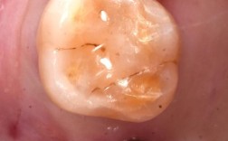 种牙切口恢复要多久？日常护理有哪些注意事项？