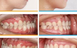 骨性地包天只做正畸，真的不用手术吗？