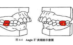 正畸咬合关系描述