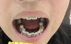 牙齿矫正拆牙套，痛不痛？