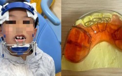 西安下兜齿正畸手术