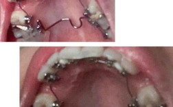 温州口腔正畸手术效果如何？安全靠谱吗？