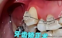 牙床高低正畸手术