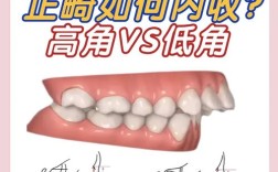 正畸U矫正器，该放上颌还是下颌？