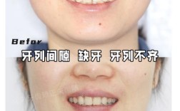 正畸后咬颌为何总不齐？矫正方案需调整？