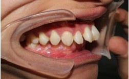 下颚突出矫正，牙齿矫正能改善脸型吗？