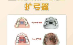 正畸快速扩弓器的简称是什么？