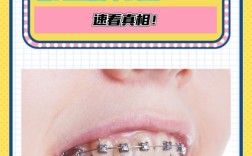 儿童正畸是否必须拔牙？关键看这些情况