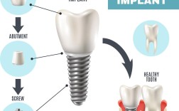 植牙BT是什么意思？BT在植牙中具体指什么？