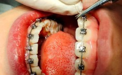 正畸治疗地包天具体有哪些方法？效果如何？有没有年龄限制？一般需要多长时间？