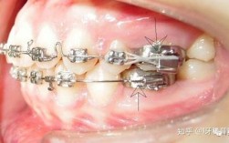 正畸用带环的原因究竟是什么？