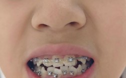 8岁儿童牙齿矫正，早干预还是等换牙？关键看哪些因素？