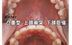 矫正牙齿后槽牙歪了？是什么原因导致的？该怎么处理？