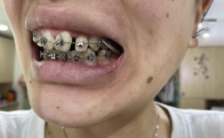 上海矫正牙齿拥挤，如何选择合适的矫正方式？