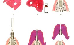 种植体取印模两方法有何不同？如何正确选择？