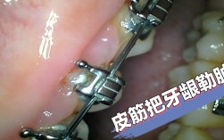 正畸牙掏根创伤