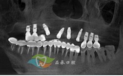 上海最早开展种植牙手术的具体时间是什么时候？