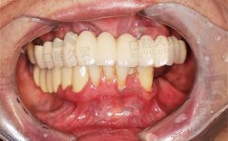 明星全口腔植牙