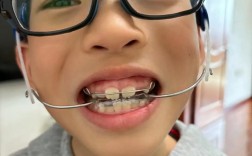 小孩矫正牙齿 痛苦