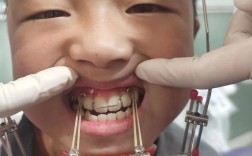 银川地包天矫正效果如何？能改善脸型吗？