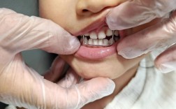 儿童矫正牙齿过程会难受吗？孩子能适应吗？