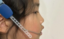 正畸头帽矫正器的适应症具体包括哪些口腔情况？