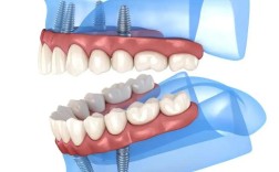 allon4种植牙费用多少？全口种植牙价格贵不贵？影响因素有哪些？