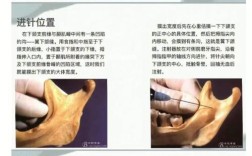 口腔麻醉方法有哪些？如何选择适合的治疗方式？