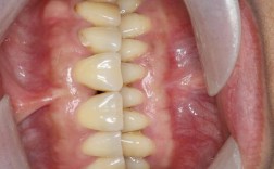 游离缺失不种牙，会有哪些不良后果？