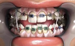 儿童虎牙矫正的最佳方法是什么？