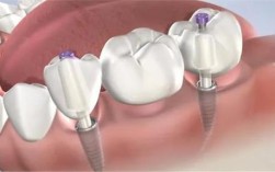 搭桥和种牙哪个好？选择关键看什么？