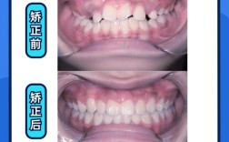 青少年龅牙矫正有哪些常见方法？不同矫正方式的适用年龄、效果及注意事项分别是什么？