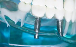 哈尔滨牙博士种牙效果如何？价格贵不贵？