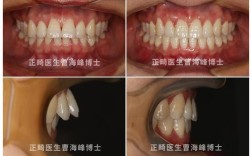 牙齿正畸为何会导致牙根外凸？原因、影响及应对方法解析
