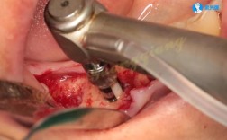 正畸前为何必须先做牙周治疗？