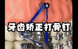 牙齿矫正拆钉子