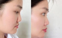 牙齿矫正会改变侧脸吗？