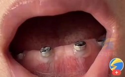 为什么种牙戴牙后会头疼？