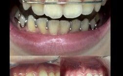 国外牙齿矫正效果真的比国内更好吗？差异在哪里？