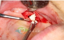 正畸 骨皮质切开术