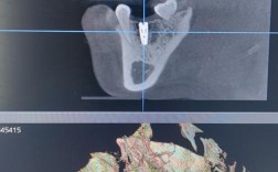 种牙x光 ct