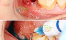 植牙后牙龈变白