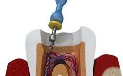 活髓牙麻醉方法有哪些常见选择及适用场景？