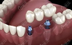 种牙材质怎么选？纯钛、锆、合金各有优劣，到底哪种更适合你的口腔状况和长期使用需求？