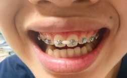 25岁矫正牙齿，后悔的年龄坎为何难迈？